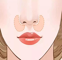 adm填充鼻基底怎么样？着重看下adm填充鼻基底的优点和缺点