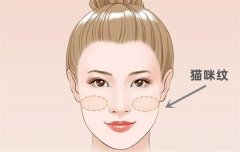猫咪纹是什么皱纹图片？猫咪纹在面部什么位置到底怎么去除