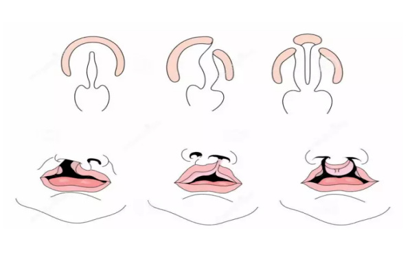 上海9院唇腭裂修复