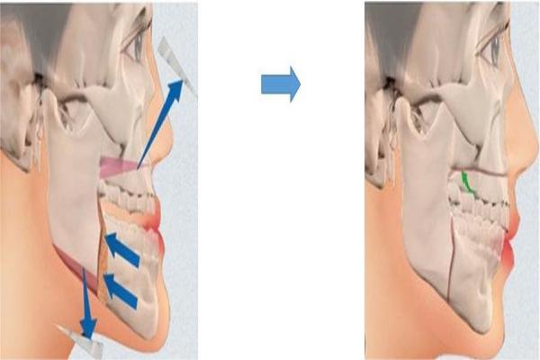 上海9院正颌手术