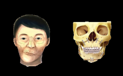 正颌手术是不是很受罪，正颌手术风险大吗，整个过程是怎么样的