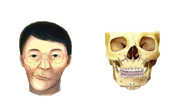 正颌手术是不是很受罪,正颌手术风险大吗,整个过程是怎么样的