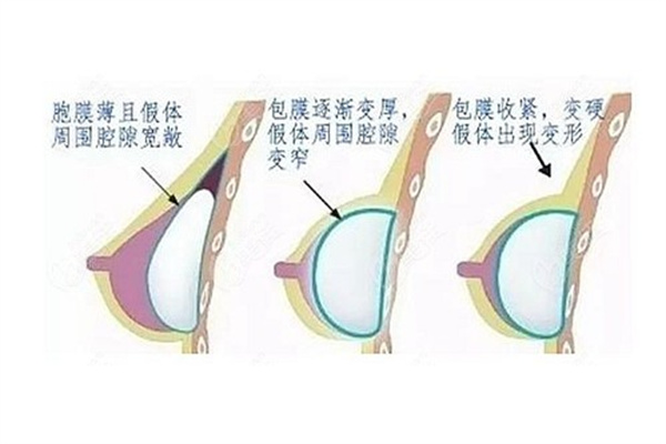 假体隆胸的危害