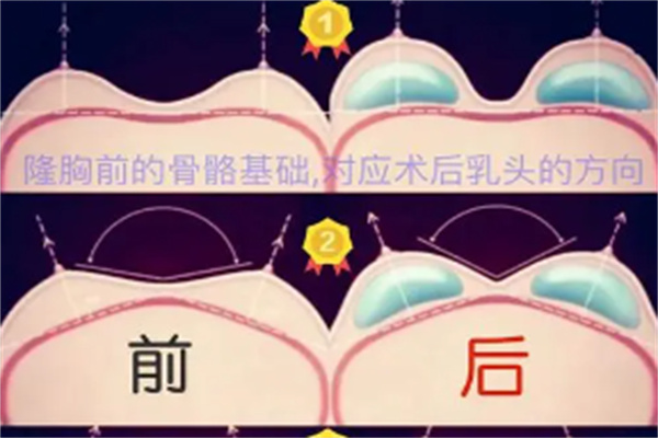 假体隆胸的疗效