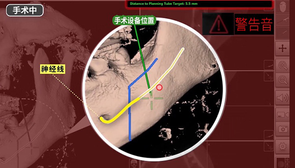 韩国id整形医院双鄂手术怎么样?导航&无捆绑双鄂手术较好技术好