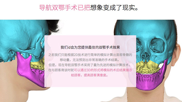 韩国id整形医院双鄂手术怎么样?导航&无捆绑双鄂手术较好技术好