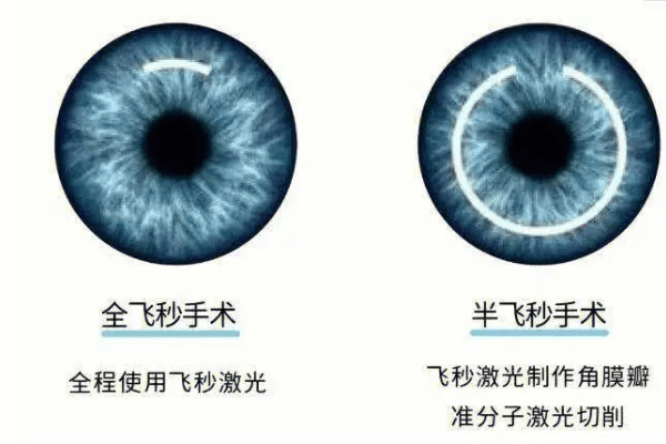 全飞秒和半飞秒近视眼手术的利弊有哪些?近视500度是不是废了呀