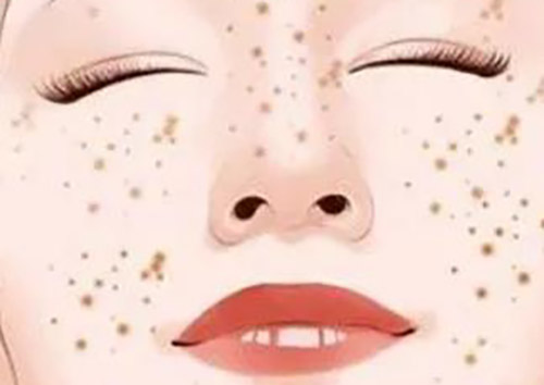 皮秒祛斑真的能去掉吗?