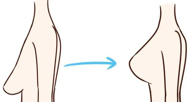 乳房下垂如何矫正