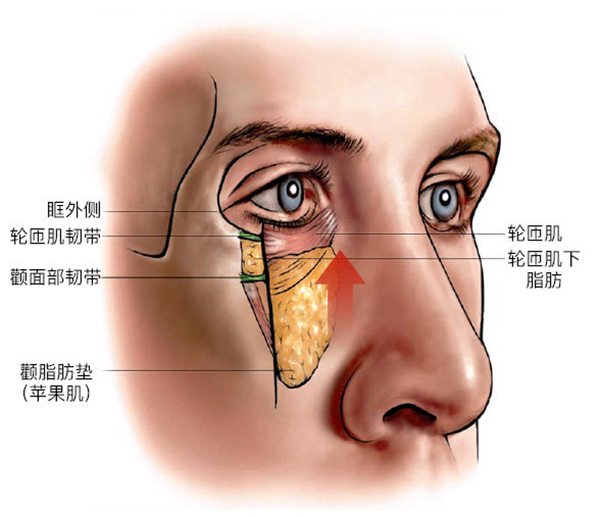 下眼睑切口面部提升术