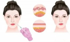 除皱针的危害和副作用简答,除皱针多久打一次 几次可以定型?