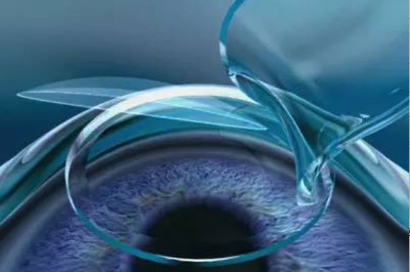 散光加近视能做全飞秒吗？本文告诉你近视眼手术较好年龄和度数