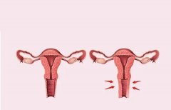 3d生物束带紧缩术和传统的有什么不一样?话说3d生物束带能缩到几指