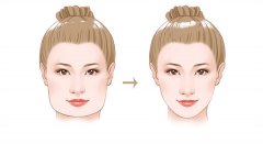 宽脸是不是只能磨骨？脸大除了磨骨还有什么办法解决