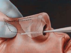 李劲良做鼻子口碑好吗？风格怎么样？集锦鼻修复实例教你怎么预约