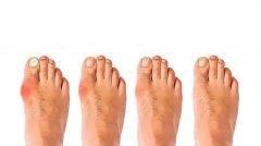 苏敬达医生口碑怎么样？坐诊北京圣嘉新做大脚骨矫正技术好