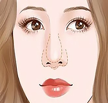 王天国桃花鼻怎么样?做鼻子真实实例分析王天国大三角支架技术特色