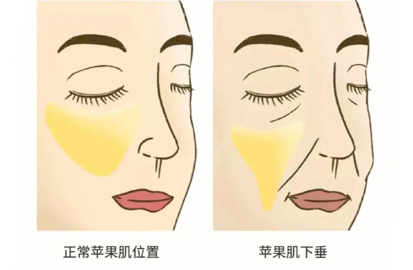 苹果肌复位采用哪种方法好?
