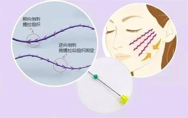 而苹果肌提升的方法有多种,包括注射提升和面部提升等。