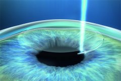 上海九院近视眼激光手术要多少钱?周激波近视手术费用预览-实例分享