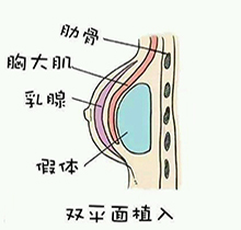 双平面隆胸一定要用内窥镜吗?分析双平面隆胸技术层次告诉你答案