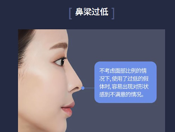 韩国ts整形外科鼻修复做的好,针对假体移位/鼻梁过高/包膜挛缩等情况