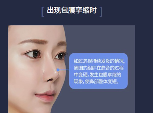 韩国ts整形外科鼻修复做的好,针对假体移位/鼻梁过高/包膜挛缩等情况