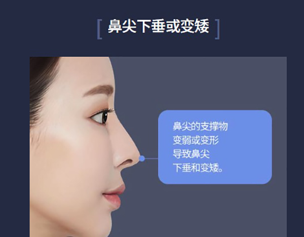 韩国ts整形外科鼻修复做的好,针对假体移位/鼻梁过高/包膜挛缩等情况