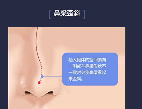 韩国ts整形外科鼻修复做的好,针对假体移位/鼻梁过高/包膜挛缩等情况