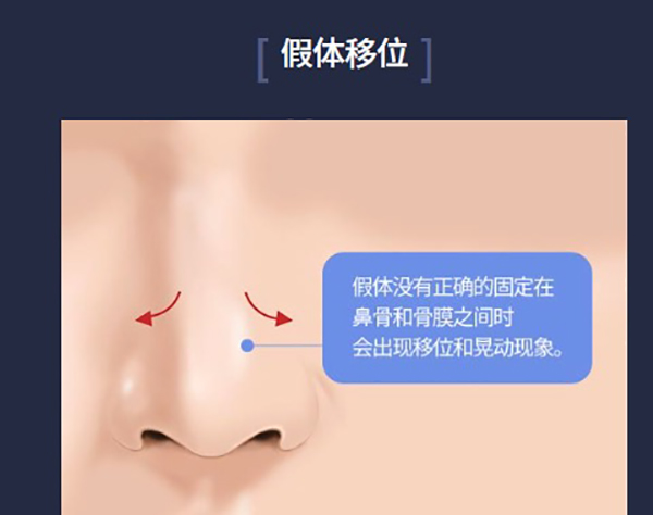 韩国ts整形外科鼻修复做的好,针对假体移位/鼻梁过高/包膜挛缩等情况