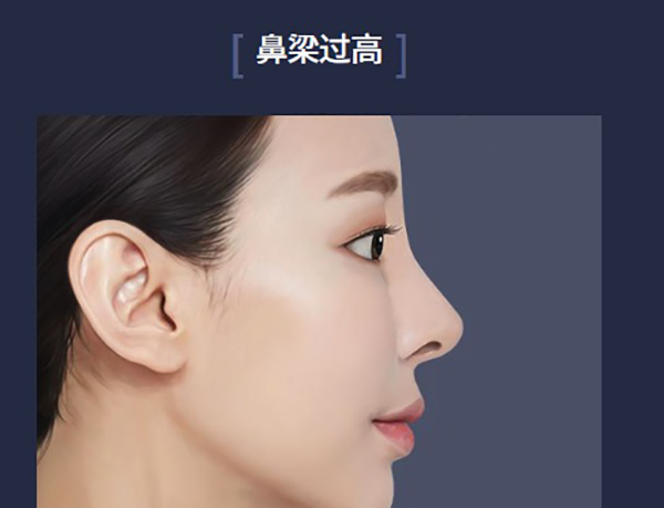 韩国ts整形外科鼻修复做的好,针对假体移位/鼻梁过高/包膜挛缩等情况