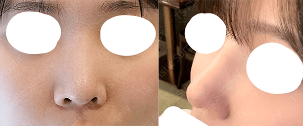 韩国ts整形外科鼻修复做的好,针对假体移位/鼻梁过高/包膜挛缩等情况
