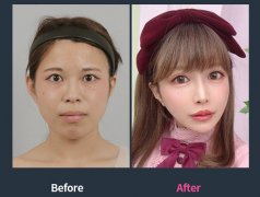 韩国id整形医院真实实例图片大全,看韩国人认可的整形医院怎么样