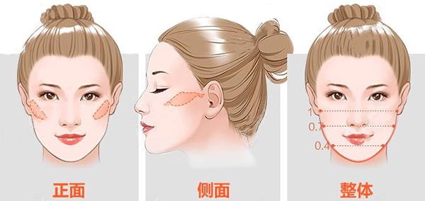 北京张笑天做颧骨手术价格