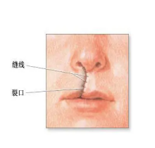  唇腭裂宝宝说话不清楚怎么办？回答唇腭裂孩子怎么进行语音训练