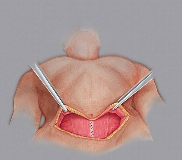 上海9院腹壁整形术多少钱
