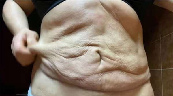 上海9院腹壁整形术多少钱