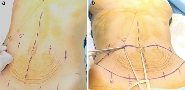 上海九人民医院腹壁整形谁做得好