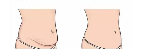 上海九人民医院腹壁整形谁做得好