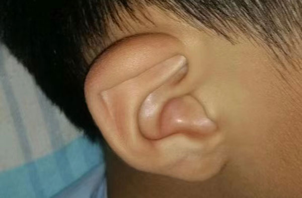 8种耳廓畸形图片中你见过杯状耳吗？一个耳朵没有耳轮是怎么回事