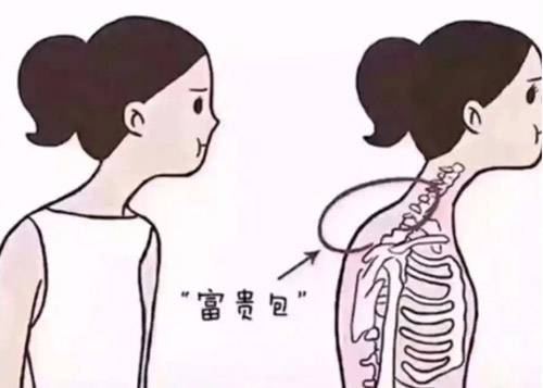 富贵包是怎么回事