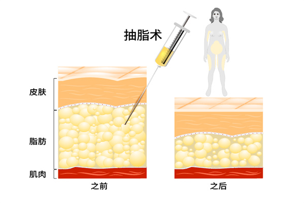 青岛大学附属医院吸脂塑形