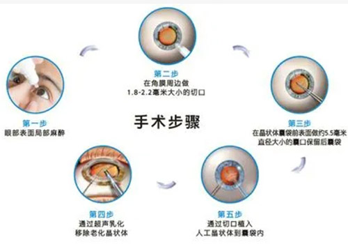 白内障超声乳化术过程