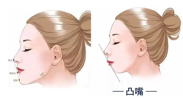 凸嘴手术后悔一辈子,我看了凸嘴手术前后对比照片真的好看