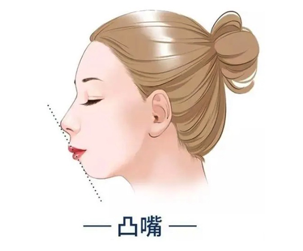 凸嘴手术后悔一辈子,我看了凸嘴手术前后对比照片真的好看