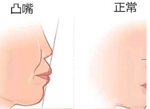 凸嘴手术后悔一辈子,我看了凸嘴手术前后对比照片真的好看