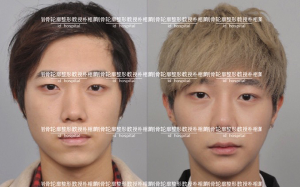凸嘴手术后悔一辈子,我看了凸嘴手术前后对比照片真的好看