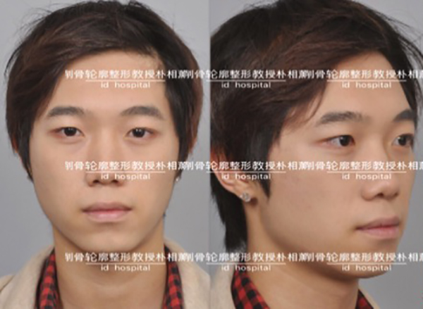 凸嘴手术后悔一辈子,我看了凸嘴手术前后对比照片真的好看