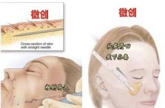 深圳万晓楠微拉美怎么样?童颜v提3.0手术保持久,坐诊医院预约挂号戳