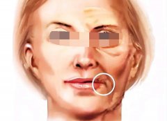 北京华韩拉皮好的医生推荐谢立宁，擅长微拉美/SMAS筋膜拉皮深层抗衰